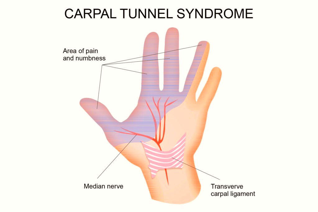 What is carpal tunnel syndrome? What is carpal tunnel syndrome?